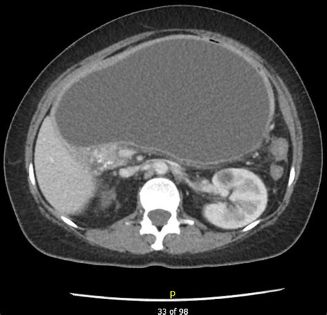 Spontaneous Rupture Of A Pancreatic Pseudocyst Bmj Case Reports