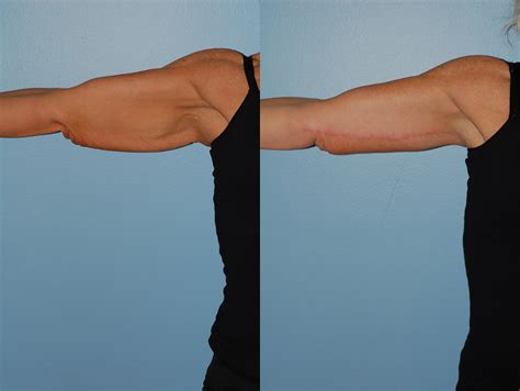 Brachioplasty Arm Lift Before And After Pictures Case 46 Ellicott