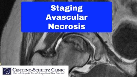 Avascular Necrosis Stages