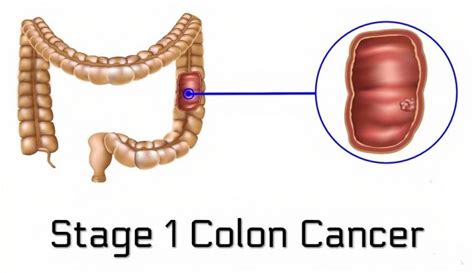How Many Stages Are There In Colon Cancer Page 3 Of 7