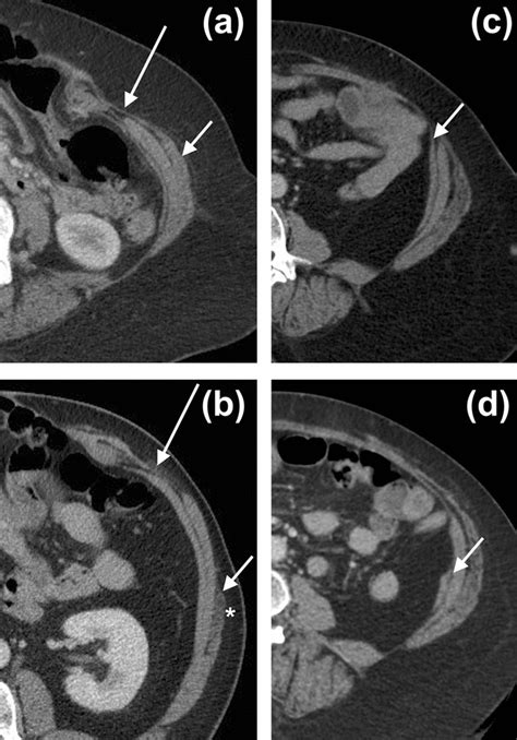 Pre And Post Operative Ct Following Anterior Component Separation A