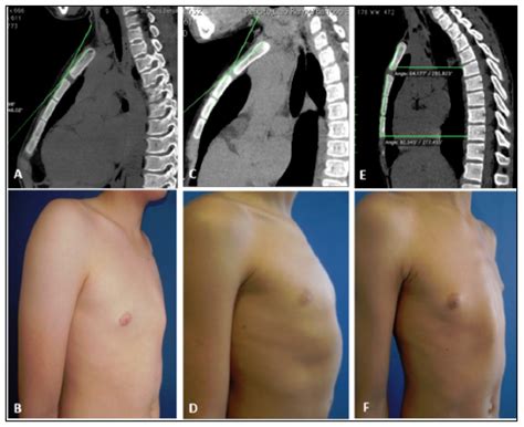 SciELO Brasil ANALYSIS OF STERNAL CURVATURE PATTERNS IN PATIENTS