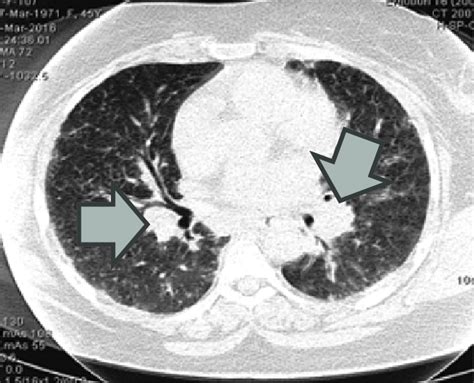 Ct Scan Of Chest Showing Bilateral Hilar Lymphadenopathy And Prominent