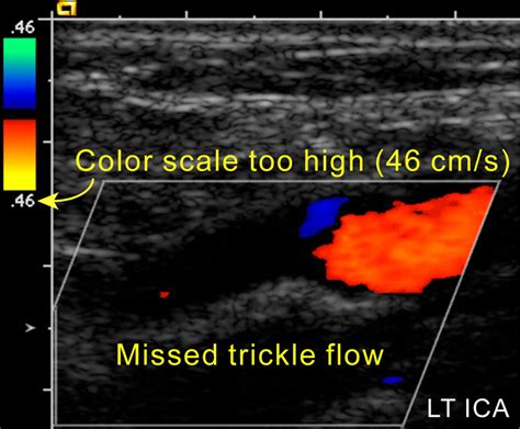 Sonographic Examination Of The Carotid Arteries Radiographics