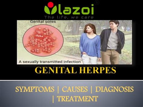 Genital Herpes Symptoms Causes Diagnosis And Treatment Ppt