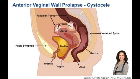 What Is Anterior Vaginal Wall Prolapse Youtube