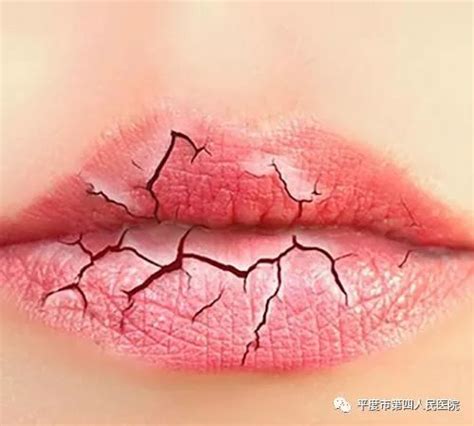 【健康】冬季嘴唇干裂脱皮怎么办？这些护唇误区莫陷入！