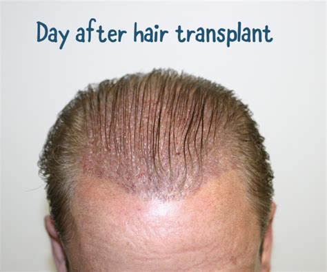 Hair Transplant After Pics Best Hairstyles Ideas For Women And Men In 2023