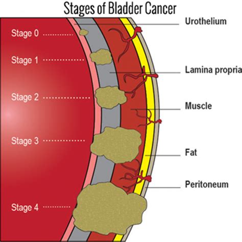 Can cats get bladder cancer. FLUTD: Feline Lower Urinary Tract Disease - Cat Renal and ...