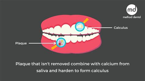The Difference Between Plaque And Calculus Method Dental