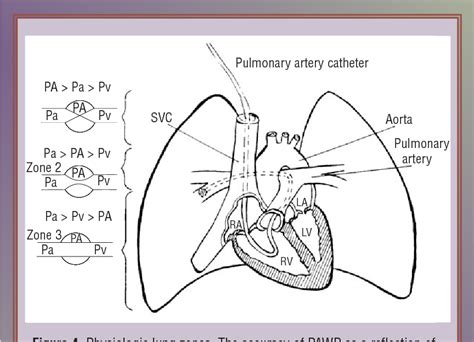 Figure 1 From Monitoring Pulmonary Artery Pressure Semantic Scholar