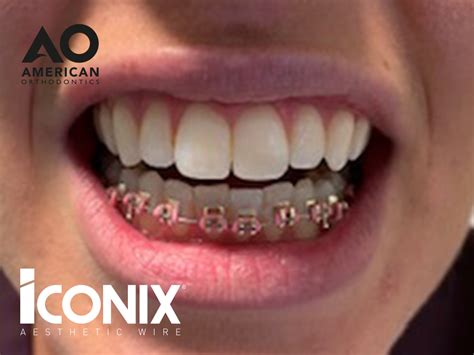 Iconix Braces At Refine Specialist Dental Care Gold Coloured Braces Orthodontics In Alfreton