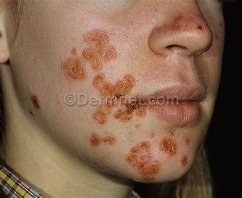 Impetigo Skin Disease Pictures Impetigo Skin Diseases