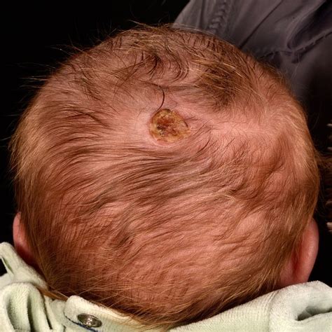 Scabs On Baby Head From Ventouse Delivery By Dr Science Photo Library