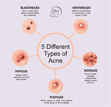 Different types of Acne | Different types of acne, Types 