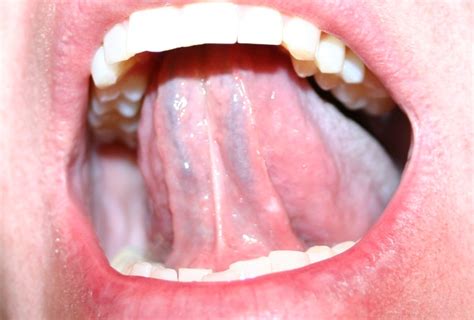 Top 10 Youtube Video Of All Time Zone White Bump Under Tongue Std Pics