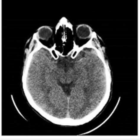 Ct Head Showing A Left Hyperdense Middle Cerebral Artery Sign Computed