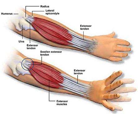 It turns… inflamed common flexor tendon cft. Tennis elbow specifically involves the area where the ...