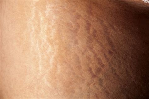 Can Stretch Marks Be Prevented The Nation Nigeria