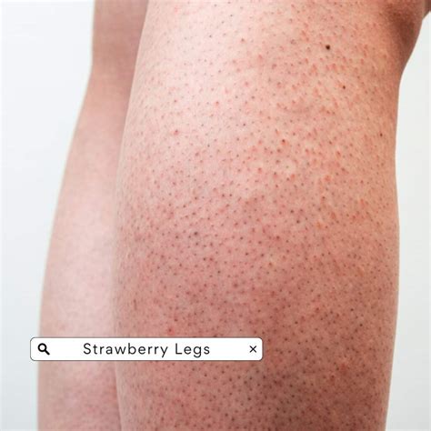Strawberry Legs Causes Treatments And Prevention