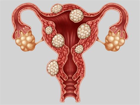 Learn about endometriosis, including possible treatments for this condition that causes pain and endometriosis occurs when bits of the tissue that lines the uterus (endometrium) grow on other. Endometriosis - what do you need to know? | Hirslanden ...