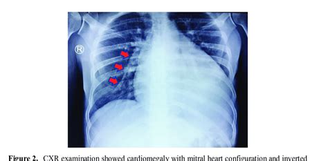 Cxr Examination Showed Cardiomegaly With Mitral Heart Configuration And