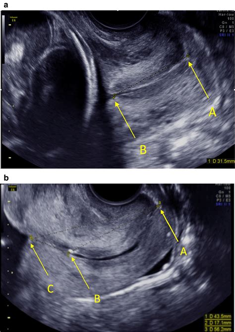 Second‐trimester Transvaginal Ultrasound Measurement Of Cervical Length