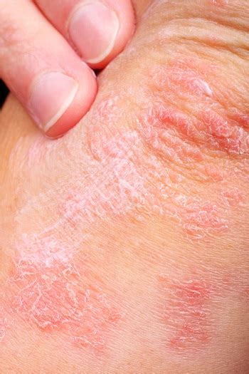 5 Common Eczema Symptoms Minimize Outbreaks Center For Dermatology