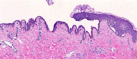 Pathology Outlines Pemphigus