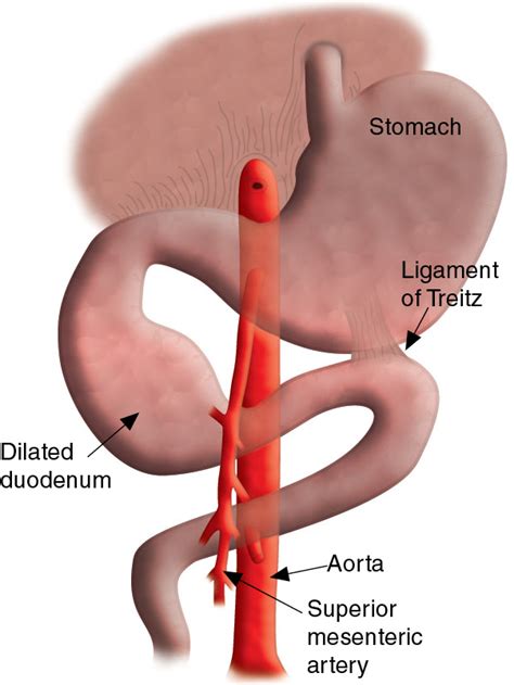 Foregut Showing Dilated Duodenum And Adjacent Structures Labeled