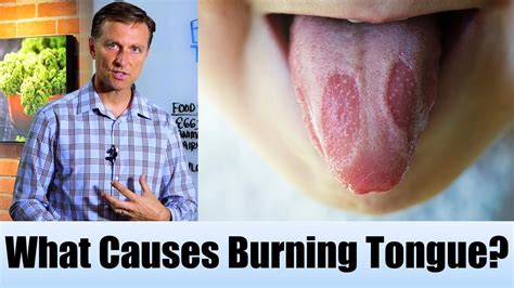 What Causes Burning Tongue Drberg Blog