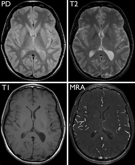 Normal Brain Mri With Contrast Images Radiologia