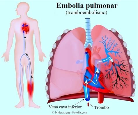 Trombosis Pulmonar Síntomas Embolia pulmonar Sintomas causas y