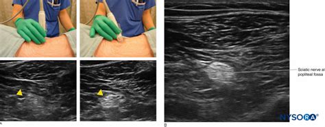 Introduction To Ultrasound Guided Regional Anesthesia Nysora