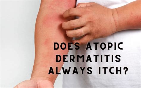Does Atopic Dermatitis Always Itch Kind Of Heaven