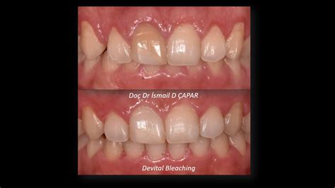 Step By Step Internal Non Vital Endodontic Bleaching Adım Adım