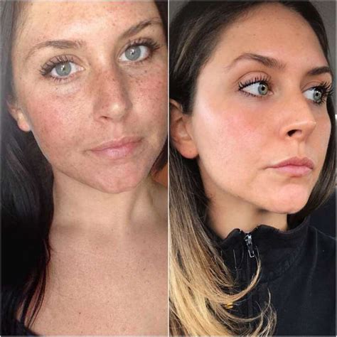 Q Switched Laser For Treating Freckles