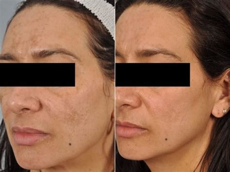 Peels And Microdermabrasion Before And After W Skin Studio