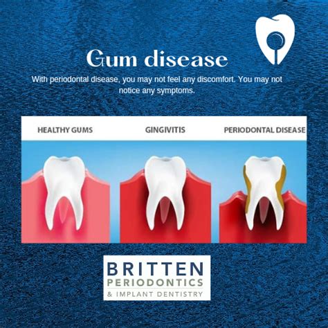 Gum Disease Insidious And Often Silent Britten Perio