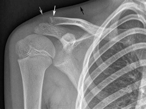 Soft Tissue Signs Shoulder Wikiradiography