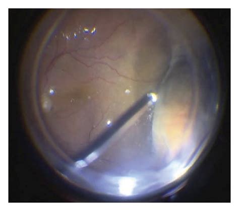 Complete Vitrectomy Peripheral Vitreous Removal With Vitreous Base