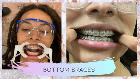 come with me to get my bottom braces gold braces power chains new updates youtube