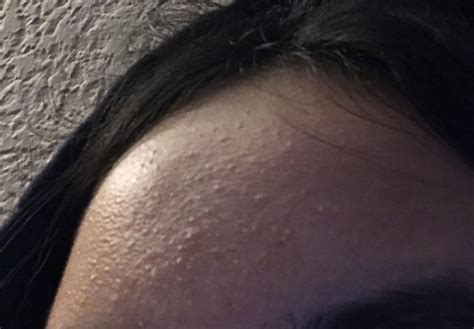 Forehead Bumps General Acne Discussion
