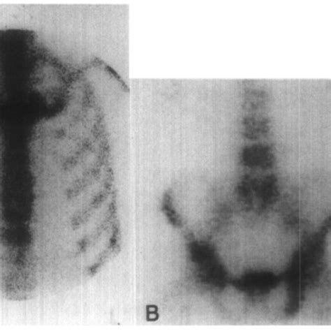 Incisional Biopsy Of Right Second Rib Lesion Reveals Metastatic