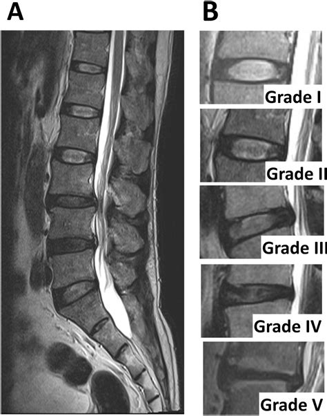 Acute Effects Of Kinesio Taping On Pain Disability And Back Extensor