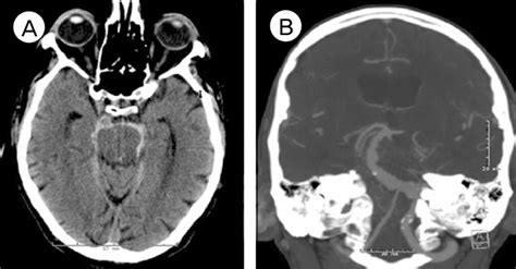 Computed Tomography Ct Of The Brain Without Contrast Left Showing