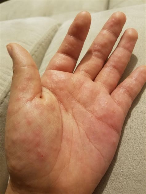 Hands Foot And Mouth Disease Of Dyshidrotic Eczema Popping