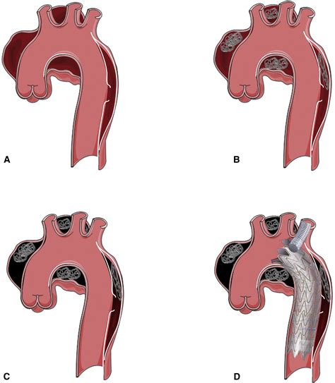 Inducing False Lumen Thrombosis For Retrograde Type A Aortic Dissection