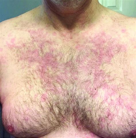 Urticarial Like Rash On The Chest Of The Patient Download Scientific