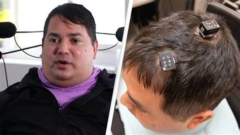 New York Brain Implant Partially Restores Feeling And Movement In